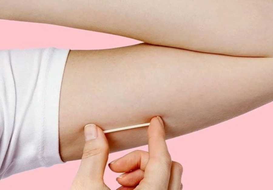 Mulheres de Belford Roxo já podem ter acesso a Implanon pelo SUS